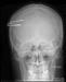 Как гвозди попали в голову этого человека, врачам оставалось только догадываться. Рентгеновский снимок сделан посмертно.